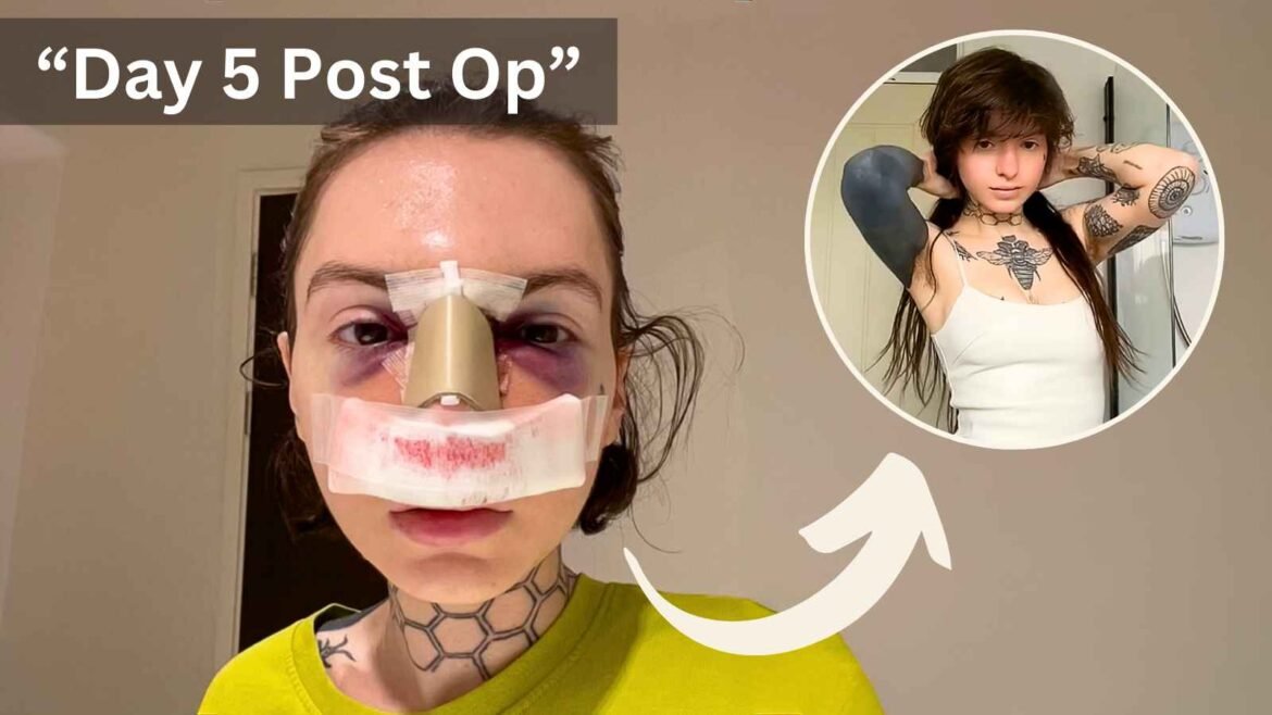 TikTok Creator Mily Moon Reveals Rhino Plasty Work