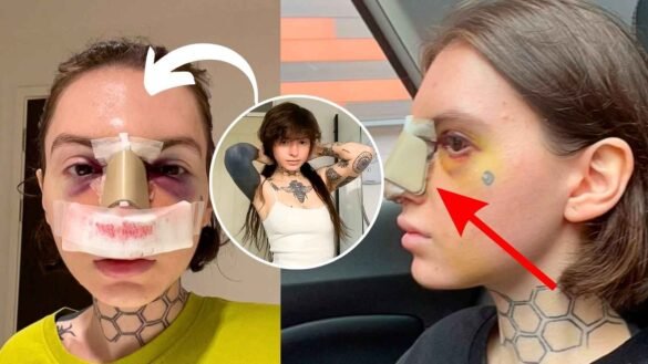 TikTok Creator Mily Moon Reveals Rhino Plasty Work 2